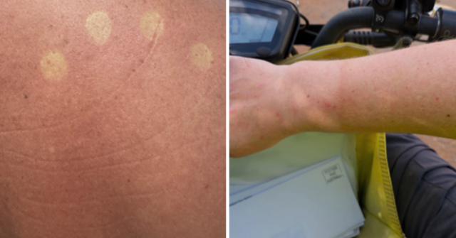 Posties disseram para parar de usar uniformes em meio a relatos de que estão ficando queimados de sol
