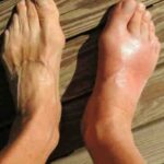 Provocando dor intensa, esses dois ingredientes naturais podem ajudar a controlar a gota