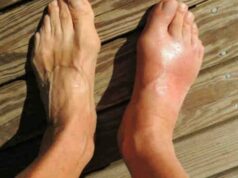 Provocando dor intensa, esses dois ingredientes naturais podem ajudar a controlar a gota Provocando dor intensa, esses dois ingredientes naturais podem ajudar a controlar a gota