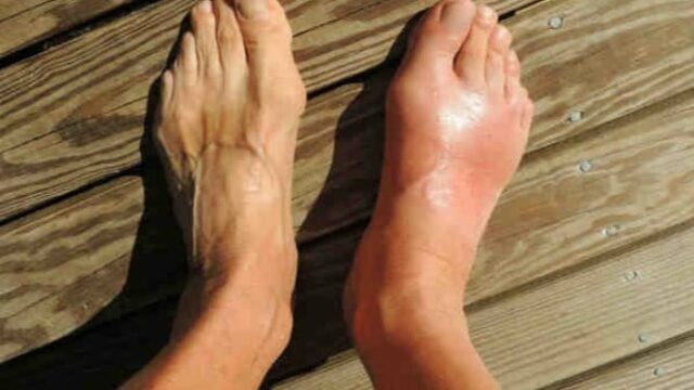 Provocando dor intensa, esses dois ingredientes naturais podem ajudar a controlar a gota
