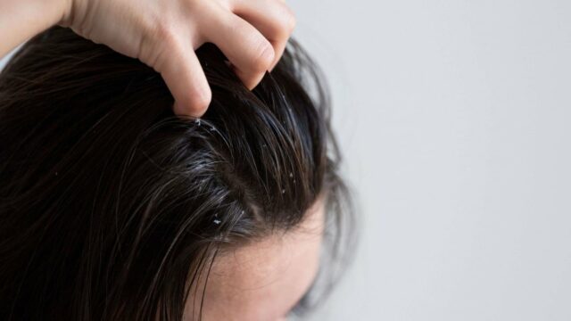 4 dicas Merawat Kulit Kepala, Cara Sederhana Cegah Ketombe e Bikin Rambut Lebih Sehat
