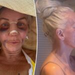 A estrela de 'RHONJ' Margaret Josephs documenta a jornada da plástica no nariz, desde curativos e hematomas até os resultados finais