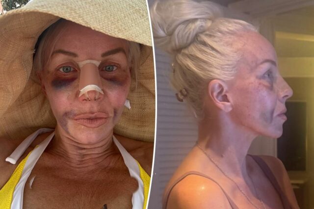A estrela de 'RHONJ' Margaret Josephs documenta a jornada da plástica no nariz, desde curativos e hematomas até os resultados finais
