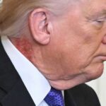Erupção cutânea vermelha intensa é vista no pescoço de Trump