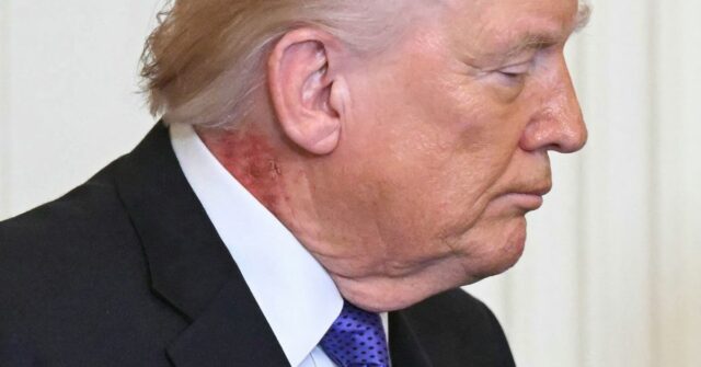Erupção cutânea vermelha intensa é vista no pescoço de Trump Erupção cutânea vermelha intensa é vista no pescoço de Trump