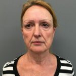 Ellen Palmer antes de seu facelift plano profundo, realizado pelo Dr. Yannis Alexandrides