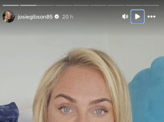 Josie Gibson revela que teve 45 por cento do braço removido em uma cirurgia de lipoaspiração em meio à batalha do lipoedema Josie Gibson revelou que passou por uma lipoaspiração e uma plástica no braço em meio à batalha contra o lipoedema