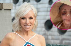 Margaret Josephs, do RHONJ, mostra resultados de plástica no nariz após recuperação brutal Margaret Josephs 58 mostra resultados de plástica no nariz depois de ser machucada e enfaixada