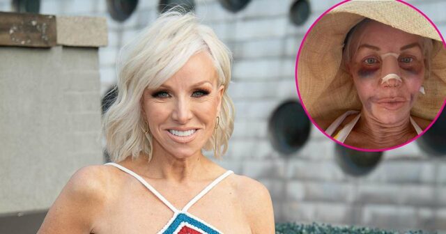 Margaret Josephs 58 mostra resultados de plástica no nariz depois de ser machucada e enfaixada