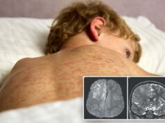 Menino de 7 anos morre de problema cerebral causado pela doença mais contagiosa do mundo – anos depois de contraí-la quando era bebê Uma criança com cabelos cacheados e uma erupção vermelha nas costas e nos braços, deitada sobre um travesseiro e lençol brancos.