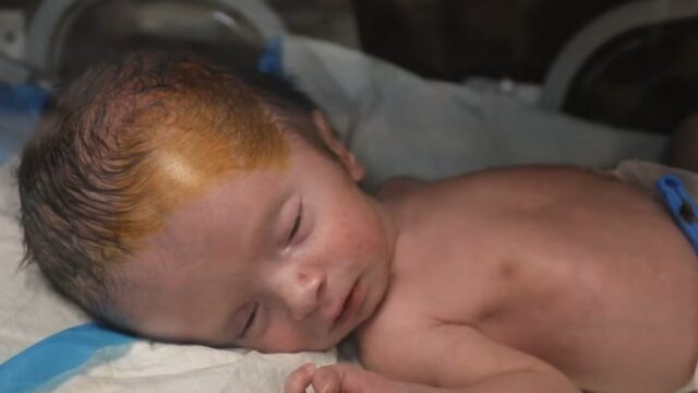 As baixas invisíveis de Gaza: um aumento no número de nados-mortos e de defeitos congénitos
