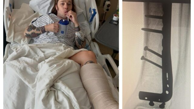 Billy Strings quebra a perna em dois lugares enquanto andava de skate durante o intervalo do encore: 'Eu ouvi isso estalar sobre a multidão gritando!'
