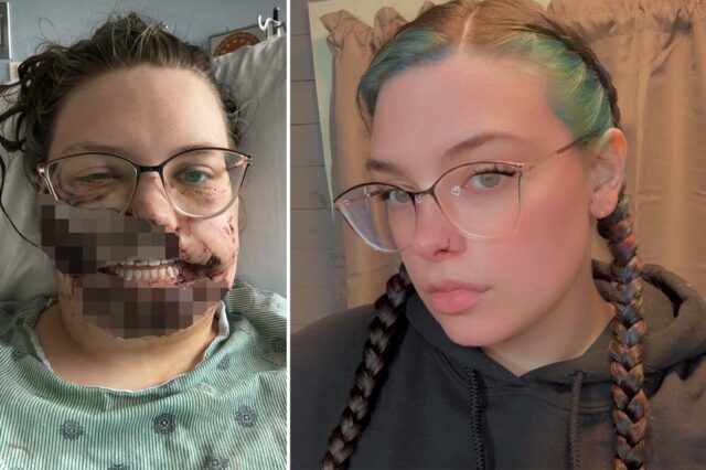 Mãe de Illinois fica com o rosto despedaçado por cão Mãe de Illinois fica com o rosto despedaçado por cão de resgate após sofrer convulsão