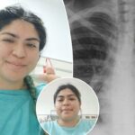 Mulher descobre que falta de piercing no nariz viajou para os pulmões, causando tosse que durou um mês