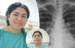 Mulher descobre que falta de piercing no nariz viajou para os pulmões, causando tosse que durou um mês Mulher descobre que falta de piercing no nariz viajou para os pulmões, causando tosse que durou um mês