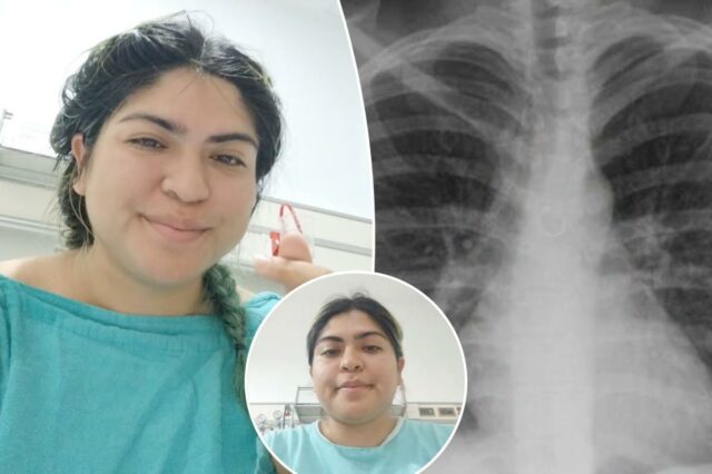 Mulher descobre que falta de piercing no nariz viajou para os pulmões, causando tosse que durou um mês
