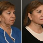 Mulheres de Nova York gastam US$ 100 mil em arriscadas cirurgias de depilação das glândulas, transformando-se em bombas mais jovens e “mais arrebatadas”