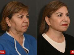 Mulheres de Nova York gastam US$ 100 mil em arriscadas cirurgias de depilação das glândulas, transformando-se em bombas mais jovens e “mais arrebatadas” Mulheres de Nova York gastam US$ 100 mil em arriscadas cirurgias de depilação das glândulas, transformando-se em bombas mais jovens e “mais arrebatadas”