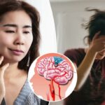 Os sutis sinais de alerta de um ‘mini acidente vascular cerebral’ – e quem corre maior risco