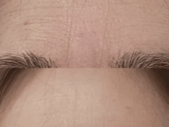 Rugas entre as sobrancelhas? Esta correção de 3 minutos leva anos Rugas entre as sobrancelhas? Esta correção de 3 minutos leva anos