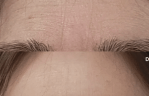 Rugas entre as sobrancelhas? Esta correção de 3 minutos leva anos Rugas entre as sobrancelhas? Esta correção de 3 minutos leva anos