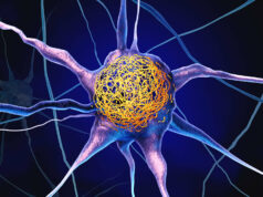 Vitamina comum pode reduzir o acúmulo de proteínas de Alzheimer, conclui estudo Vitamina D