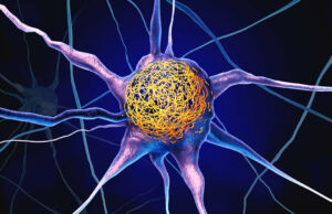 Vitamina comum pode reduzir o acúmulo de proteínas de Alzheimer, conclui estudo Vitamina D