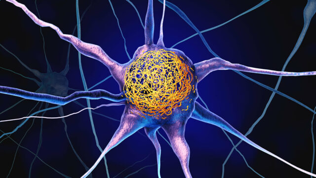 Vitamina comum pode reduzir o acúmulo de proteínas de Alzheimer, Vitamina D