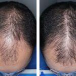 A pílula experimental para queda de cabelo acabou de superar um grande obstáculo – quando poderia chegar às prateleiras