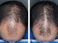 A pílula experimental para queda de cabelo acabou de superar um grande obstáculo – quando poderia chegar às prateleiras A pílula experimental para queda de cabelo acabou de superar um grande obstáculo – quando poderia chegar às prateleiras