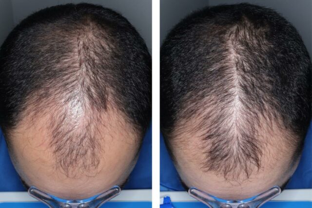 A pílula experimental para queda de cabelo acabou de superar um grande obstáculo – quando poderia chegar às prateleiras
