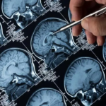 Baixo acúmulo de gordura abdominal na meia-idade está associado à atrofia cerebral lenta