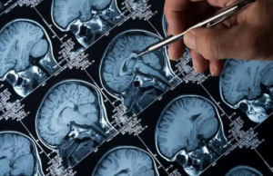 Baixo acúmulo de gordura abdominal na meia-idade está associado à atrofia cerebral lenta Baixo acúmulo de gordura abdominal na meia-idade está associado à atrofia cerebral lenta