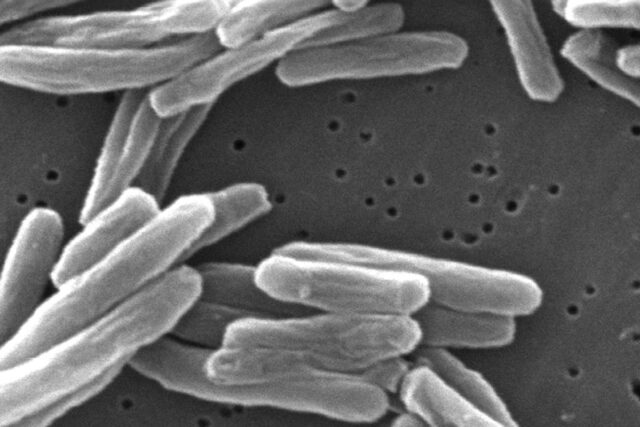 CDC alerta que grandes surtos de tuberculose duplicaram nos EUA desde meados da década de 2010
