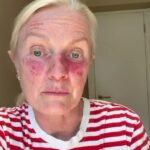 A ceratose actínica de Lorraine teve que ser tratada com um 'quimio-creme' chamado Tolak para destruir as células cancerígenas - mas deixou seu rosto vermelho e com dores constantes