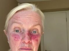 Durante anos ignorei uma pequena mancha vermelha no rosto e presumi que fosse parte do envelhecimento. Então um médico me disse o que REALMENTE era. Eu nunca tinha ouvido falar disso… mas é por isso que você deve fazer um check-out A ceratose actínica de Lorraine teve que ser tratada com um 'quimio-creme' chamado Tolak para destruir as células cancerígenas - mas deixou seu rosto vermelho e com dores constantes