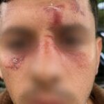 Fotos fornecidas pelo Campiagn Against Antisemitism mostram a extensão dos ferimentos do homem