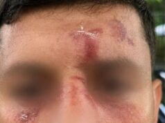Judeu que visitava Londres é atacado por gangue de homens mascarados ‘depois de falar hebraico em seu celular’ nas primeiras horas da manhã Fotos fornecidas pelo Campiagn Against Antisemitism mostram a extensão dos ferimentos do homem