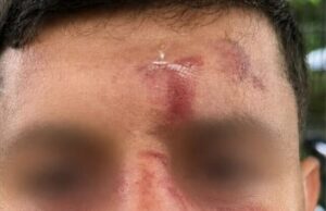 Judeu que visitava Londres é atacado por gangue de homens mascarados ‘depois de falar hebraico em seu celular’ nas primeiras horas da manhã Fotos fornecidas pelo Campiagn Against Antisemitism mostram a extensão dos ferimentos do homem