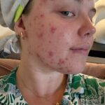 Chloe teve acne pela primeira vez quando tinha 13 anos. Aos 16, ela já havia experimentado todos os cremes e géis e, aos 17, seu médico lhe prescreveu pílula anticoncepcional na esperança de que curasse sua acne.