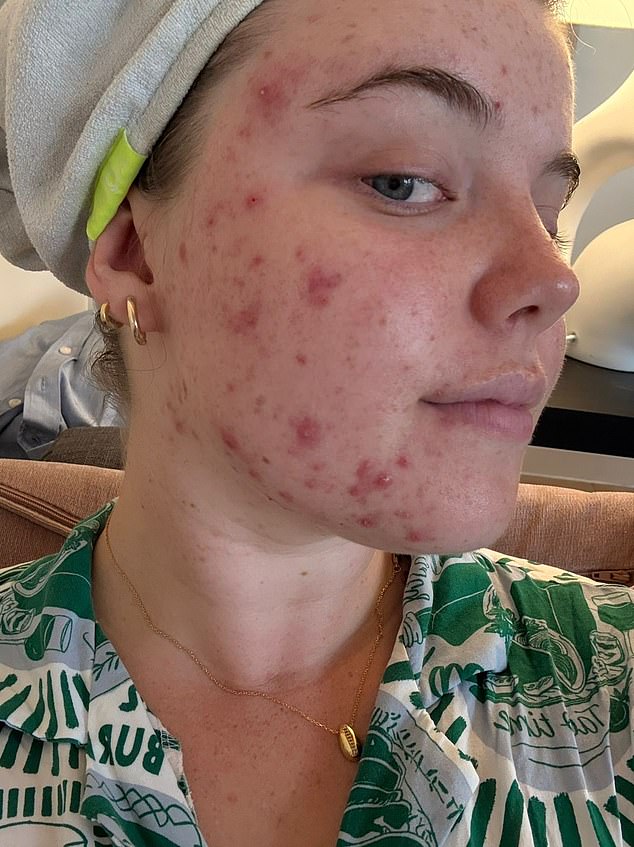 Chloe teve acne pela primeira vez quando tinha 13 anos. Aos 16, ela já havia experimentado todos os cremes e géis e, aos 17, seu médico lhe prescreveu pílula anticoncepcional na esperança de que curasse sua acne.