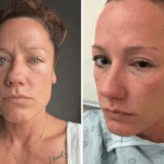 Leigh Stanger, 43, opening her eye in hospital.