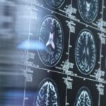 Exame de sangue pode dizer quando os sintomas de Alzheimer estão se formando