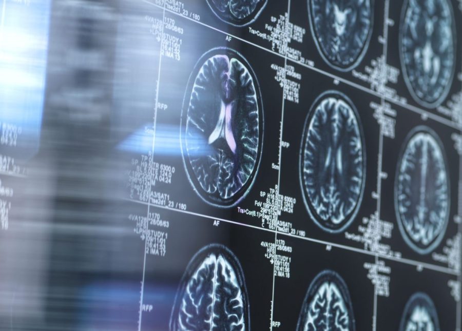Exame de sangue pode dizer quando os sintomas de Alzheimer estão se formando