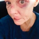 Gail Porter revelou um olho roxo e um corte no lábio depois que ela foi derrubada das escadas em uma estação de metrô de Londres na semana passada, enquanto ela apressava os guerreiros do teclado para serem “gentis com ela”.
