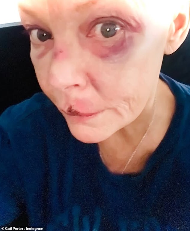 Gail Porter revelou um olho roxo e um corte no lábio depois que ela foi derrubada das escadas em uma estação de metrô de Londres na semana passada, enquanto ela apressava os guerreiros do teclado para serem “gentis com ela”.