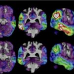 A doença de Alzheimer é a forma mais comum de demência