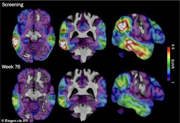 A doença de Alzheimer é a forma mais comum de demência